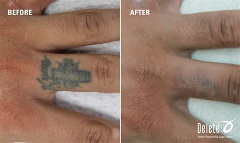 How painful is tattoo removal on finger?