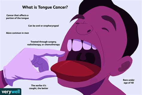 How painful is tongue cancer?