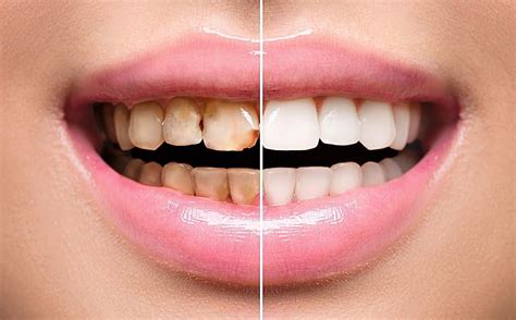 How quickly can gum disease be reversed?