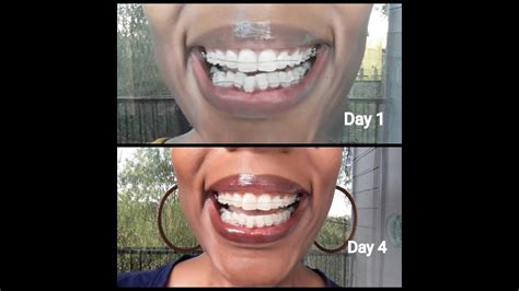 How quickly do teeth move with braces?