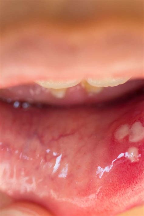 How quickly does HPV show up in mouth?