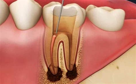 How rare is a failed root canal?
