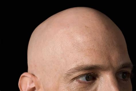 How rare is being bald?