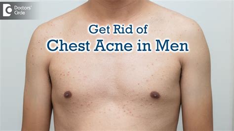 How rare is chest acne?