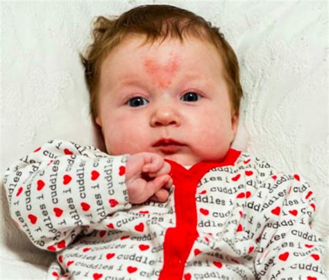 How rare is it to be born with a birthmark?