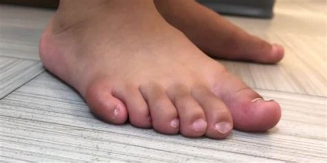 How rare is it to have 11 toes?