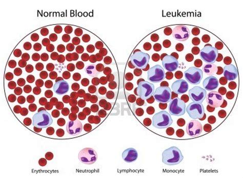 How rare is leukemia?