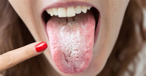How rare is oral thrush?