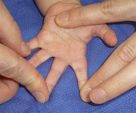 How rare is syndactyly?