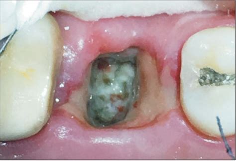 How should an extraction hole look?