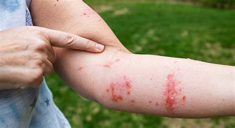 How should you sleep when you have poison ivy?