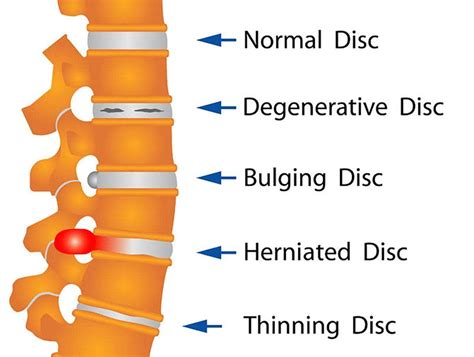 How sore is a bulging disc?