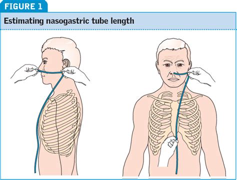 How to confirm the correct position of nasogastric feeding tubes in adults?