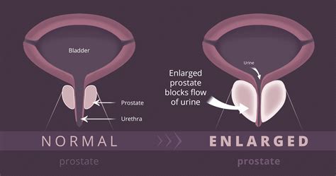 How to feel prostate quora?