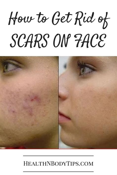 How to get rid of scars?