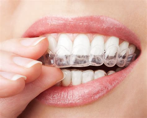 How to get straight teeth?