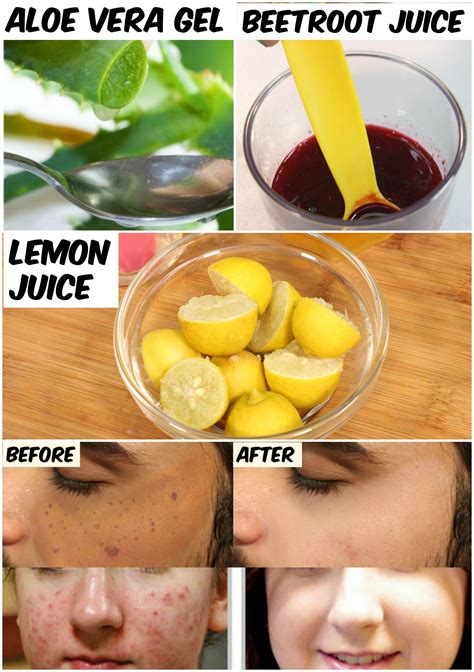 How to remove acne naturally?