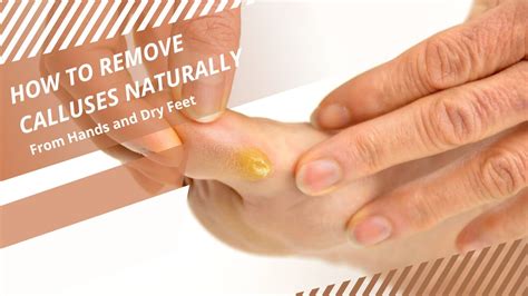 How to remove calluses?