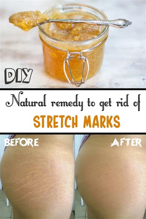 How to remove stretch marks naturally?