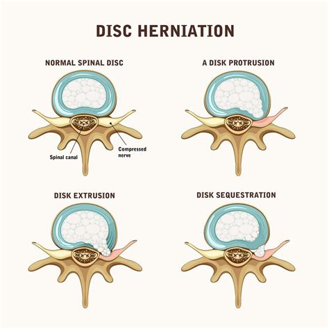How to tell the difference between a bulging disc and a herniated disc?