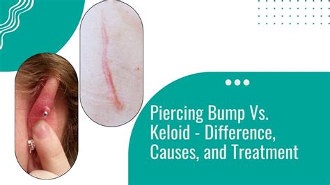 How to tell the difference between a keloid and piercing bump?