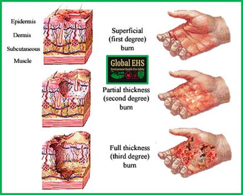 How to tell the difference between first and second degree burns?