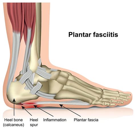 How to tell the difference between plantar fasciitis and Achilles tendonitis?