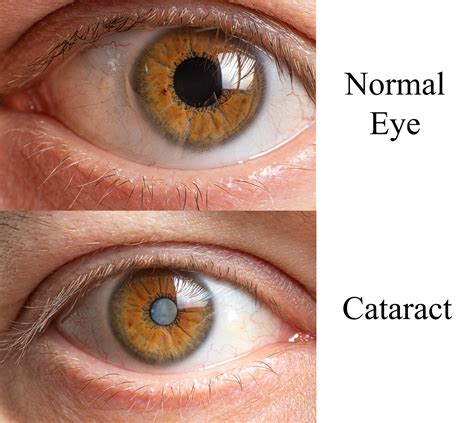 Is 0.25 normal for eyes?