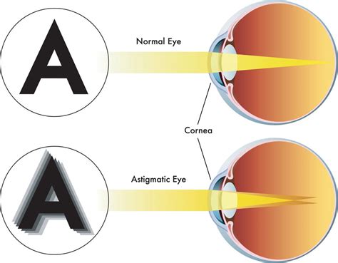 Is 0.50 astigmatism noticeable?