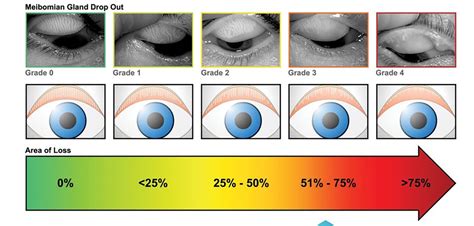 Is 1.25 eye grade high?