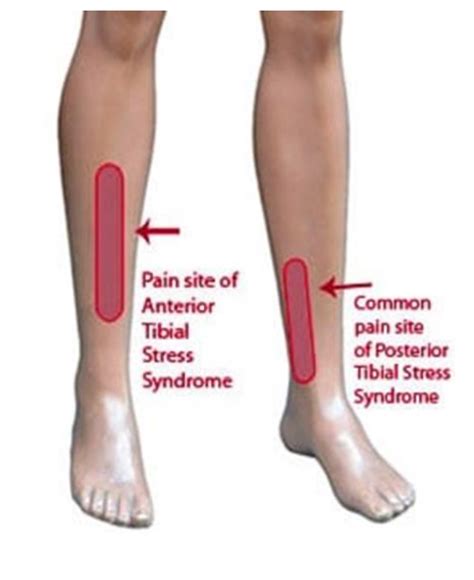 Is 2 days of rest enough for shin splints?