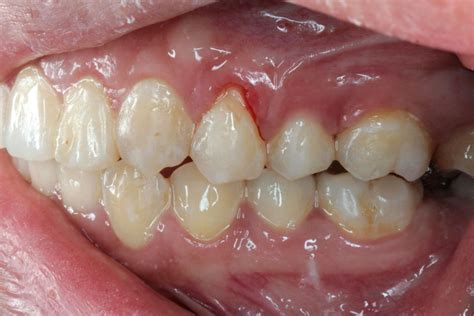 Is 2mm gum recession bad?