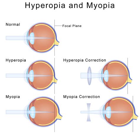 Is 3.00 myopia bad?