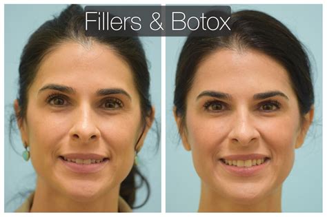 Is 35 too old to start Botox?
