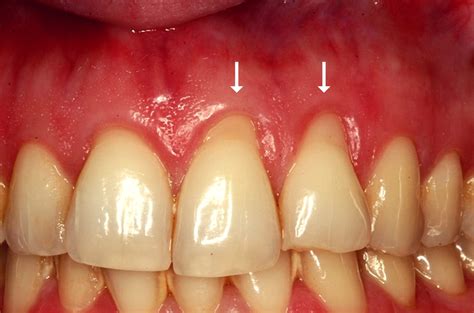 Is 3mm gum recession bad?