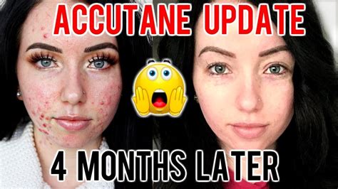 Is 4 months of Accutane enough?