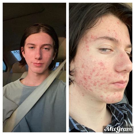 Is 4 months on Accutane enough?