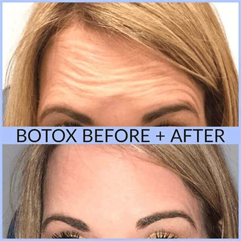 Is 40 too late for Botox?