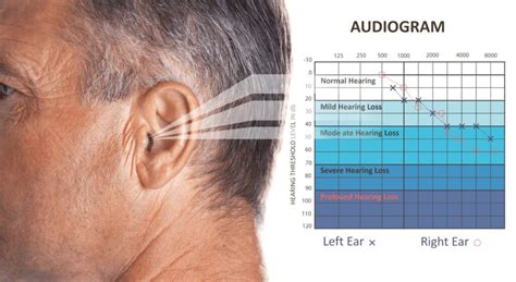 Is 50% hearing loss a disability?