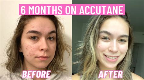 Is 6 months on Accutane enough?