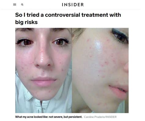 Is Accutane worth it for mild acne?