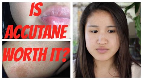 Is Accutane worth the risk?