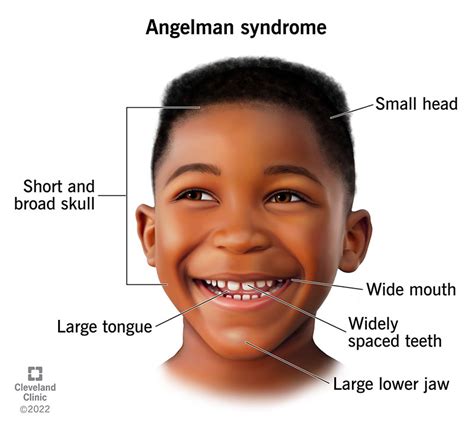 Is Angelman autistic?