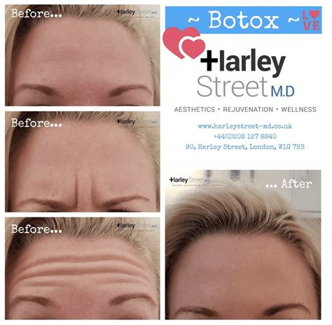 Is Botox 100% safe?