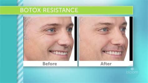 Is Botox Resistance permanent?