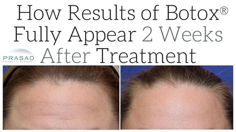 Is Botox settled after a week?