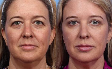 Is Botox under eyes safe?