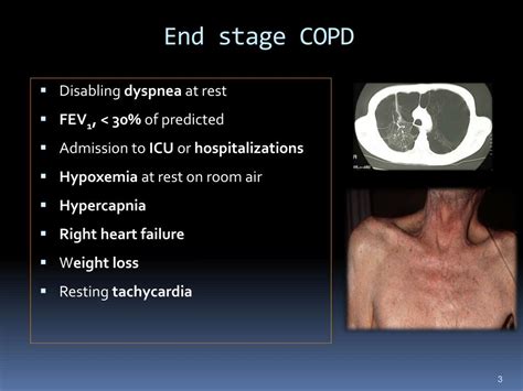 Is COPD expected to end in death?