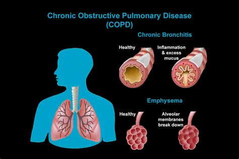 Is COPD type 1 or 2?