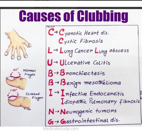 Is GI bad for fingers?